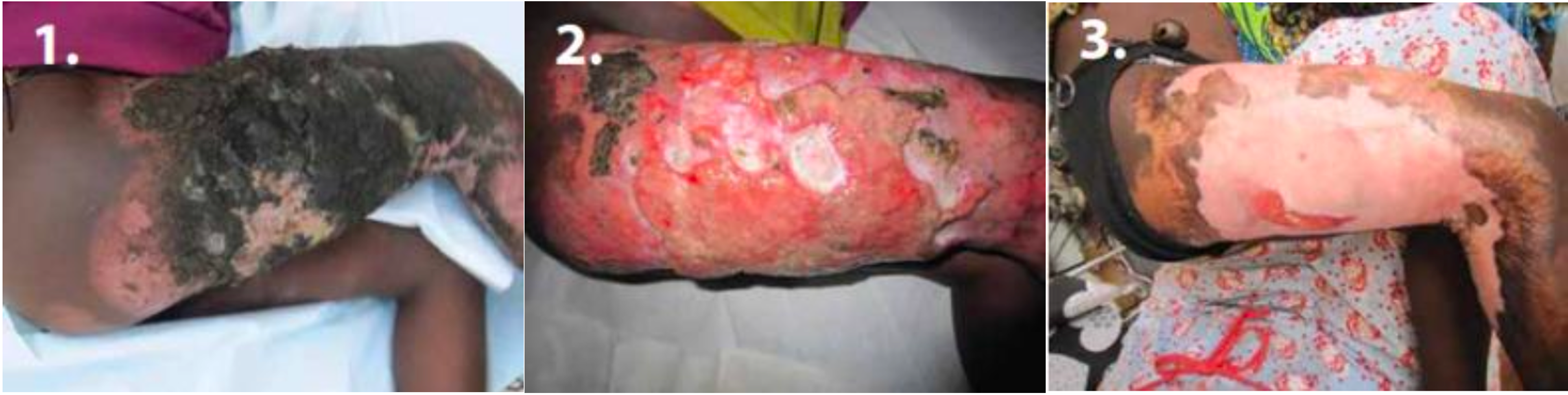 Severe burn injury before Abilar&reg; treatment, 2 months later and after Abilar&reg; treatment (5 months later)